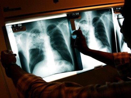 tuberculosis TB