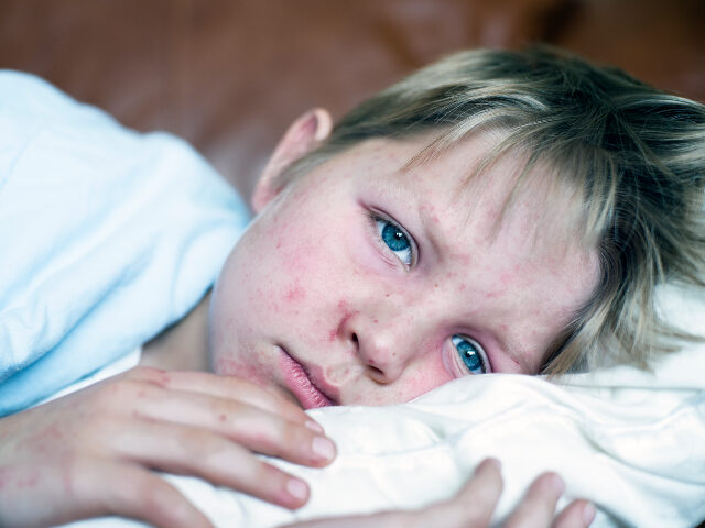 Measles
